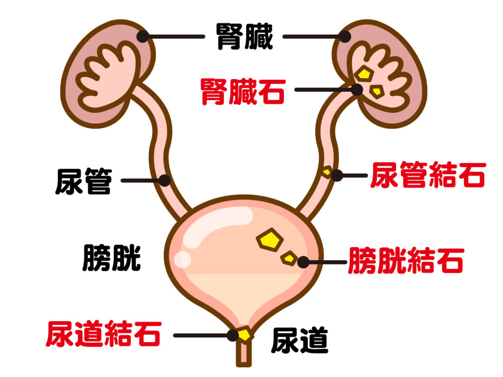腎結石、腎石灰化と言われたら
